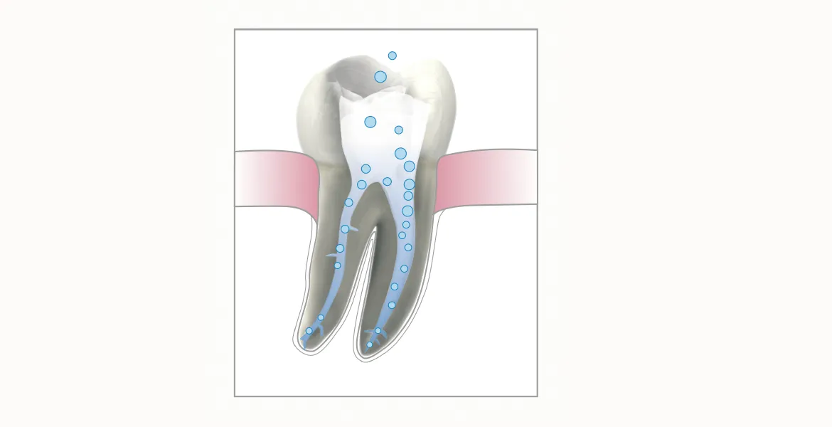 Endodontie: Mit Reciproc und starken optischen Vergrößerungen haben wir bei Wurzelkanalbehandlungen viel Erfolg. Patienten in Mettmann freuen sich, wenn wir Zähne retten.