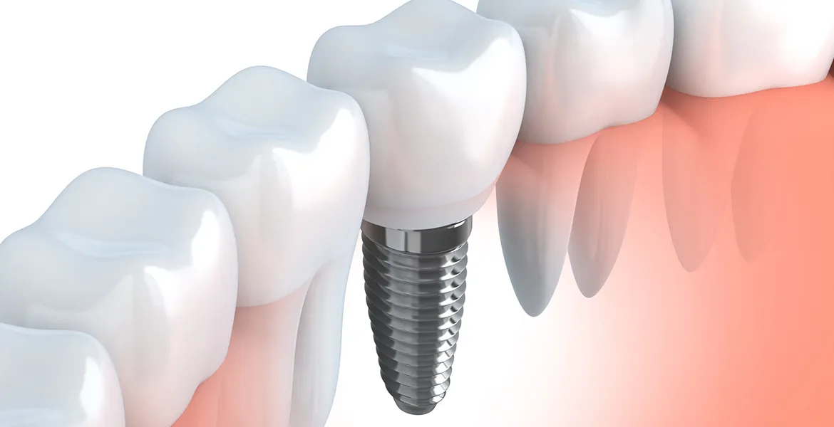 Implantate: Wir bieten Implantate an.