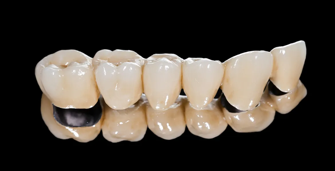 Fester Biss mit neuen Zähnen: Neue festsitzende Zähne sind wie Perlenschmuck.